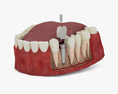 Implante dentário Modelo 3d