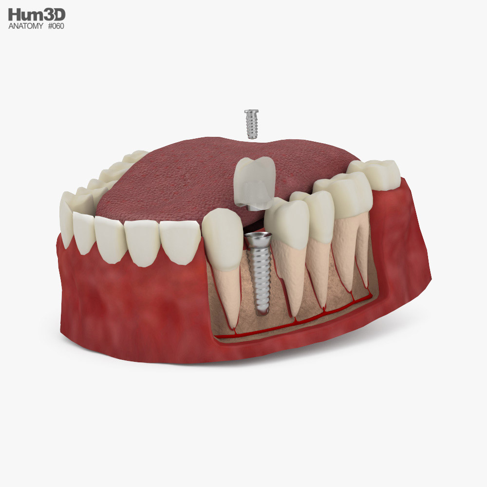 Dental Implant 3D model