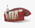 Implante dentário Modelo 3d
