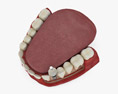 Dental Implant 3d model