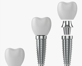 Tooth Implant 3D-Modell