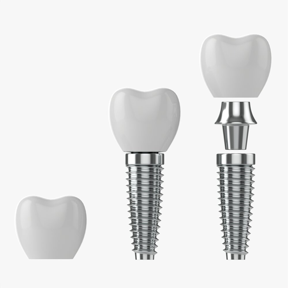 Tooth Implant 3D 모델 