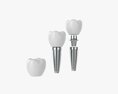 Tooth Implant 3d model