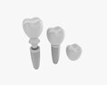 Tooth Implant 3D 모델 